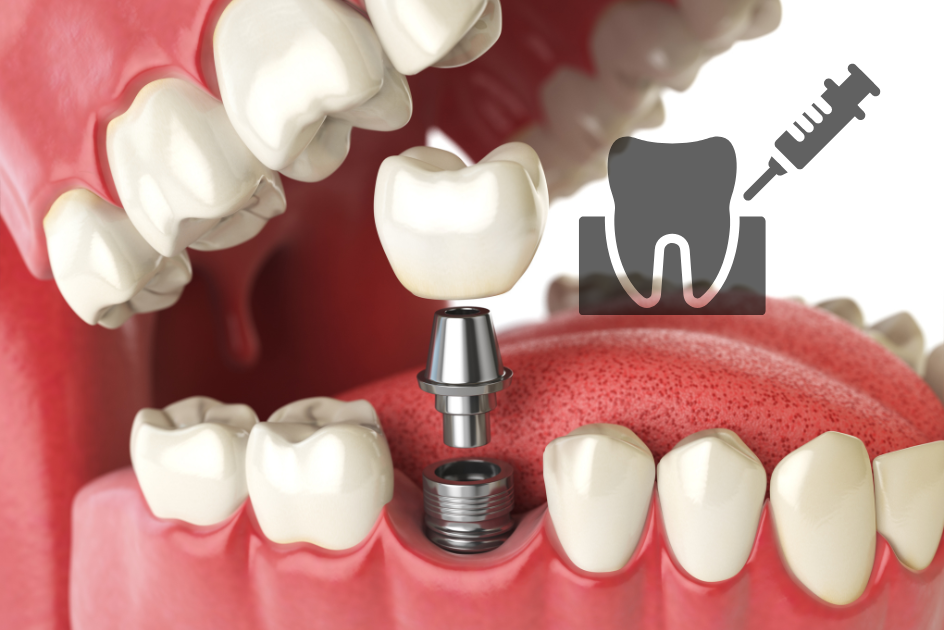 A computer rendered image displaying the assembly of a dental implant