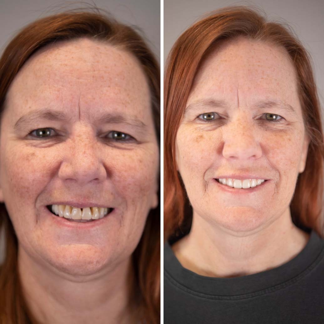 two images of the same person before and after full dental implants