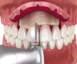 A rendering of the Crown Lengthening procedure