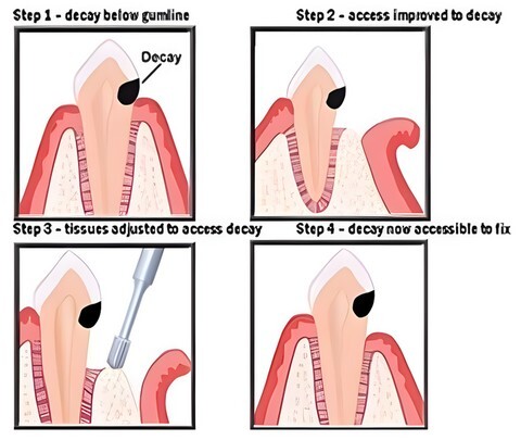 crown lengthening procedure graph